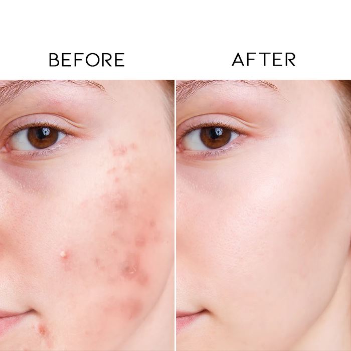 2% Salicylic Acid Exfoliating Serum Skin Care Every Day And Night 