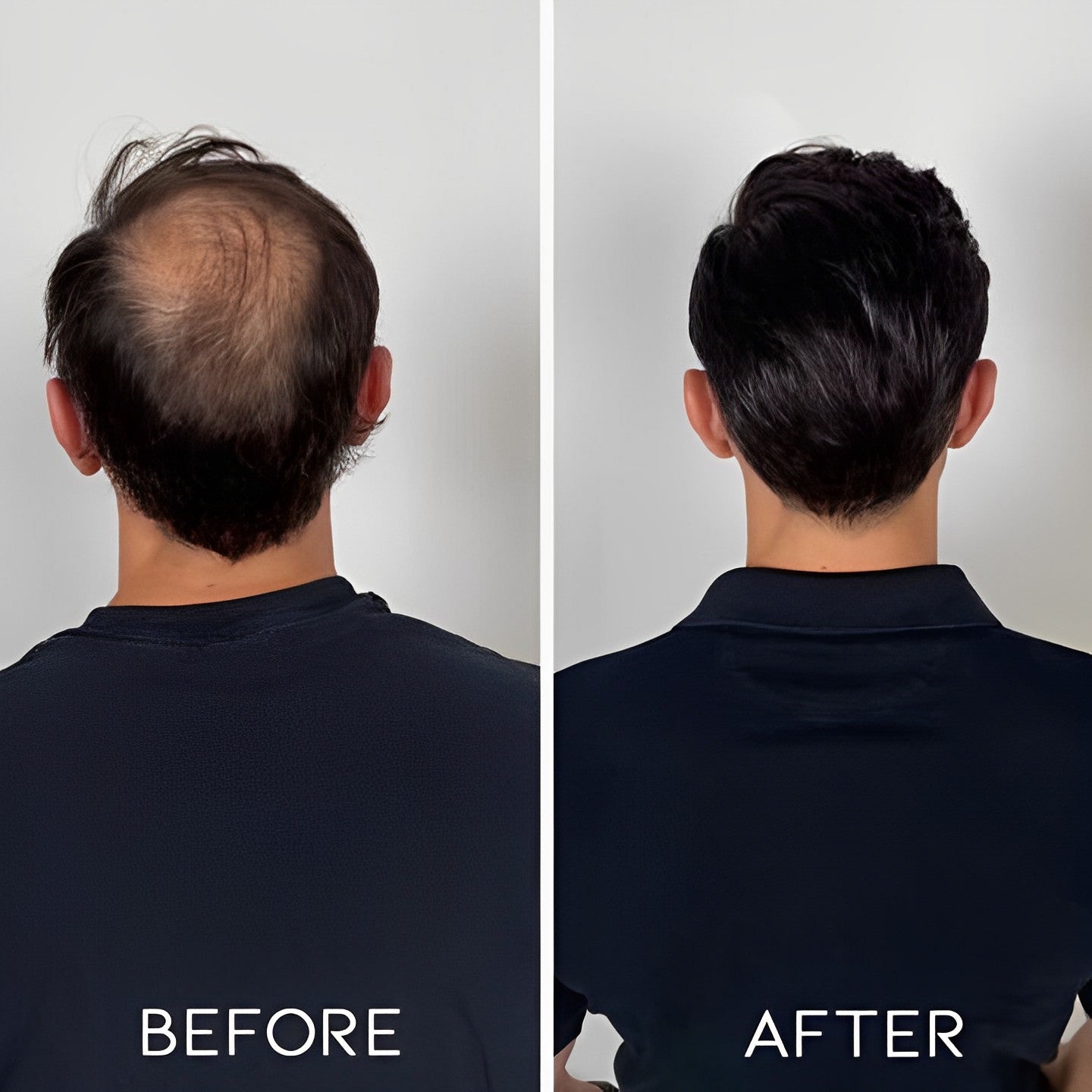 Microneedling Face Roller Personal Care Every Day And Night 