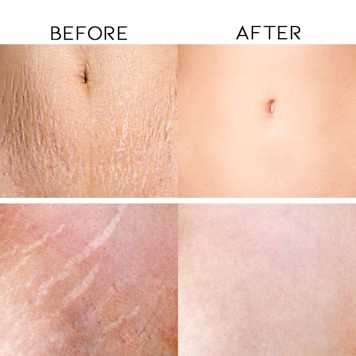 Scar & Stretch Marks Treatment Skin Care Every Day And Night 