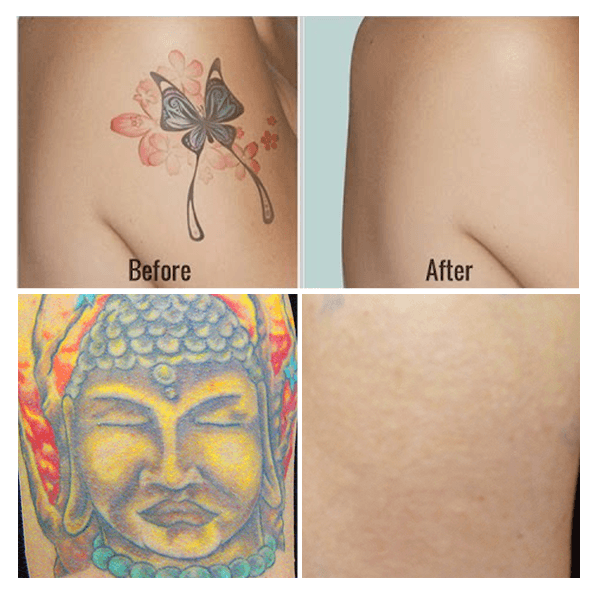 Permanent Tattoo Removal Cream