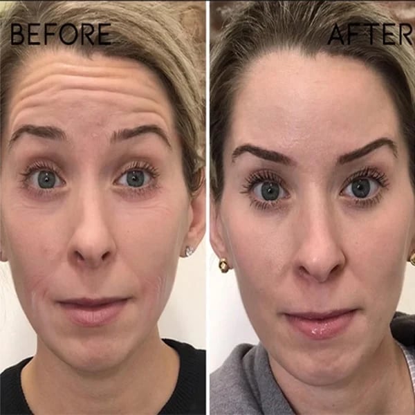 Fivfivgo™ 30 Tage Advanced Kollagen Boosten Anti-Ageing Botox Gesichtsserum