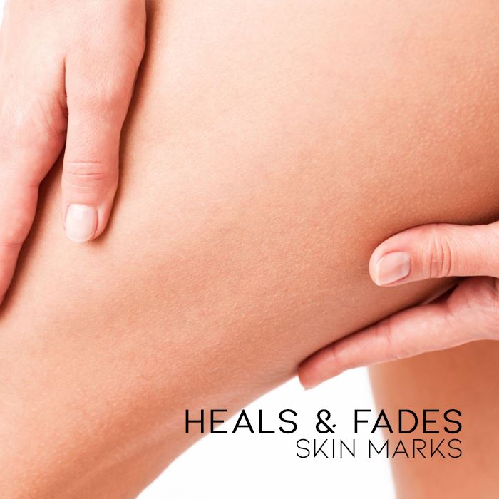 Scar & Stretch Marks Treatment Skin Care Every Day And Night 