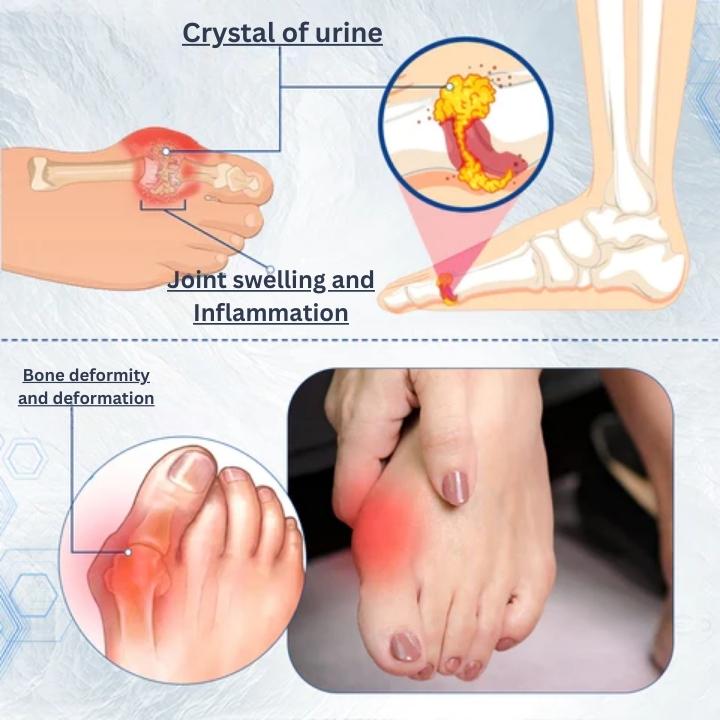 Fivfivgo™ Hallux-Valgus Correction Aid