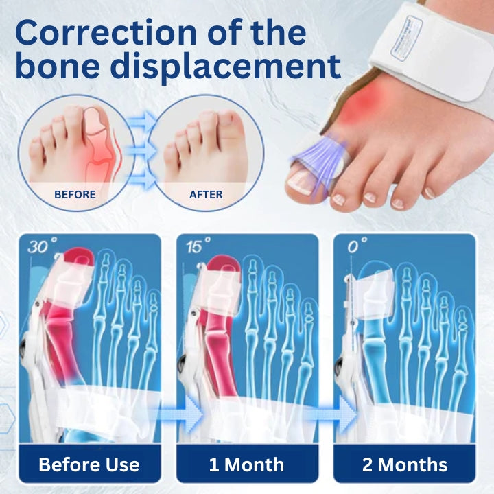 Fivfivgo™ Aide à la correction de l'hallux-valgus