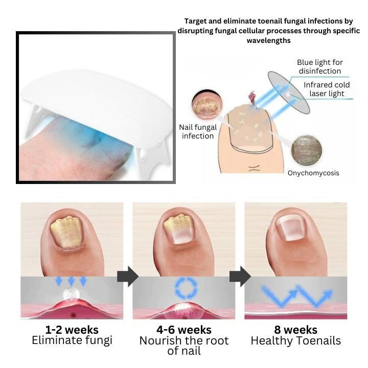 Fivfivgo™ Dispositif révolutionnaire de luminothérapie pour les maladies des ongles d'orteils