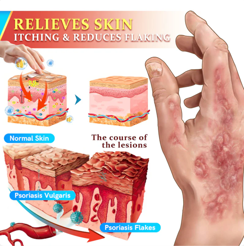 Fivfivgo™ Psoriasis Antibacterial Treatment Cream