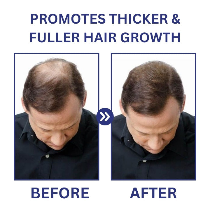 Fivfivgo™ PotentGRO Rouleau de traitement des cheveux