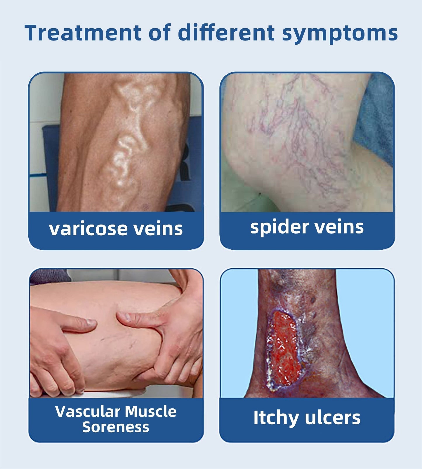 Fivfivgo™ PRO Spray contre les varices