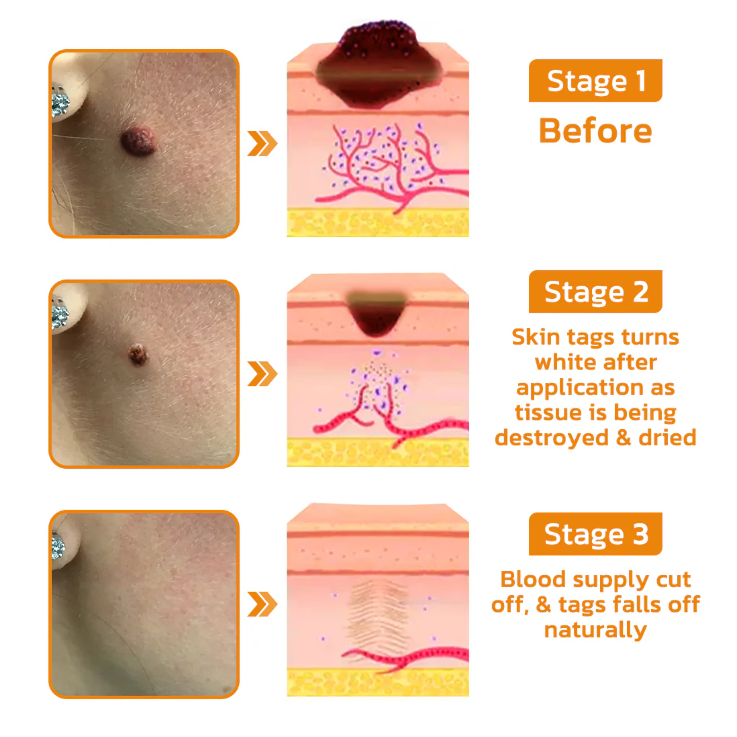 Fivfivgo™ Bee Venom Warts & Blemish Remover