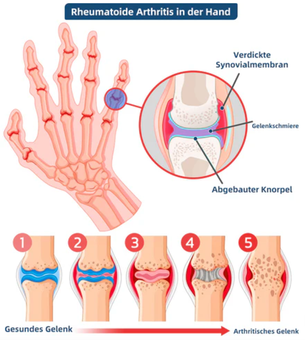 Fivfivgo™ Bienengift Fortgeschrittenes Gelenkt und Knochentherapie-Creme (Neuseeländischer Bienenextrakt - Spezialisiert auf orthopädische Erkrankungen und Arthritisschmerzen)