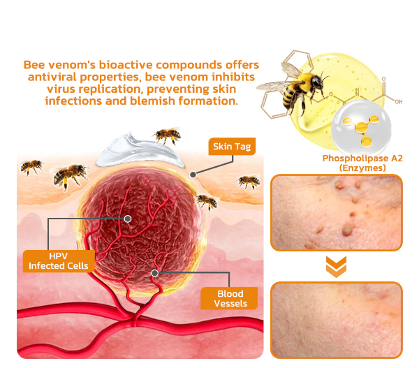 Fivfivgo™ Bee Venom Warts & Blemish Remover