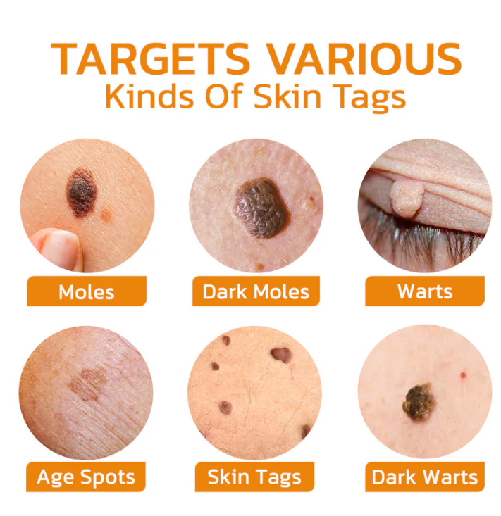 Fivfivgo™ Bee Venom Warts & Blemish Remover