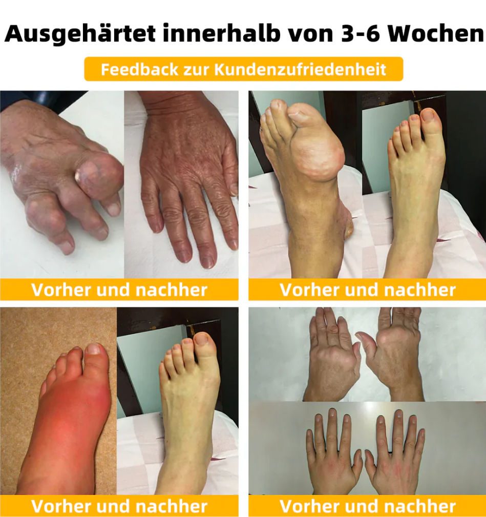 Fivfivgo™ Bienengift Fortgeschrittenes Gelenkt und Knochentherapie-Creme (Neuseeländischer Bienenextrakt - Spezialisiert auf orthopädische Erkrankungen und Arthritisschmerzen)