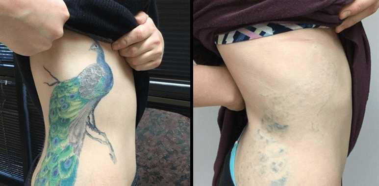 Permanent Tattoo Removal Cream