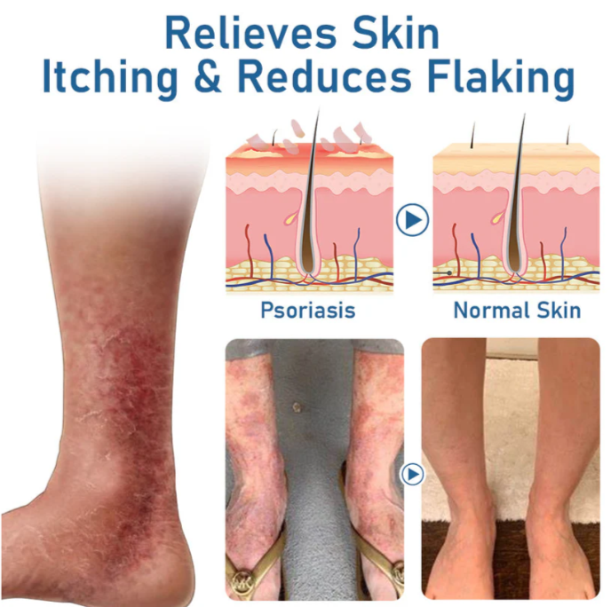 Fivfivgo™ Psoriasis Feuchtigkeits- und Beruhigungscreme
