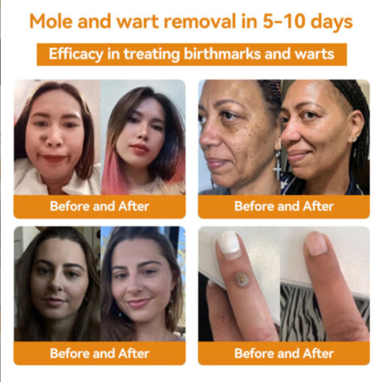 Fivfivgo™ Bee Venom Warts & Blemish Remover
