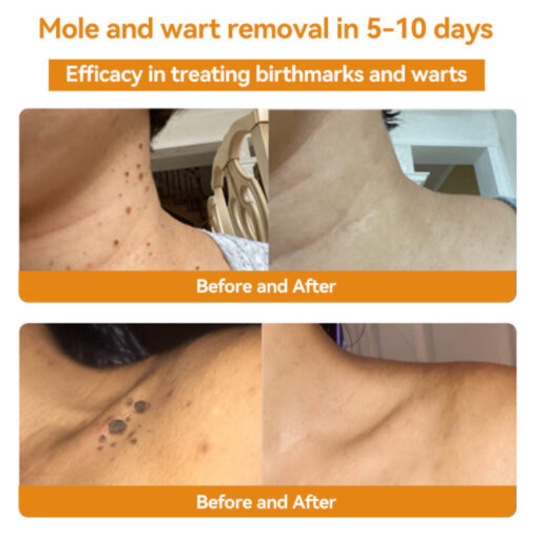 Fivfivgo™ Bee Venom Warts & Blemish Remover