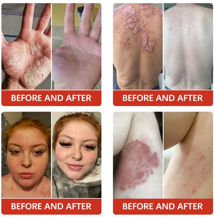 Fivfivgo™ Psoriasis Antibacterial Treatment Cream