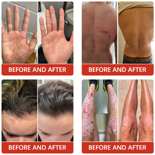 Fivfivgo™ Psoriasis Antibacterial Treatment Cream
