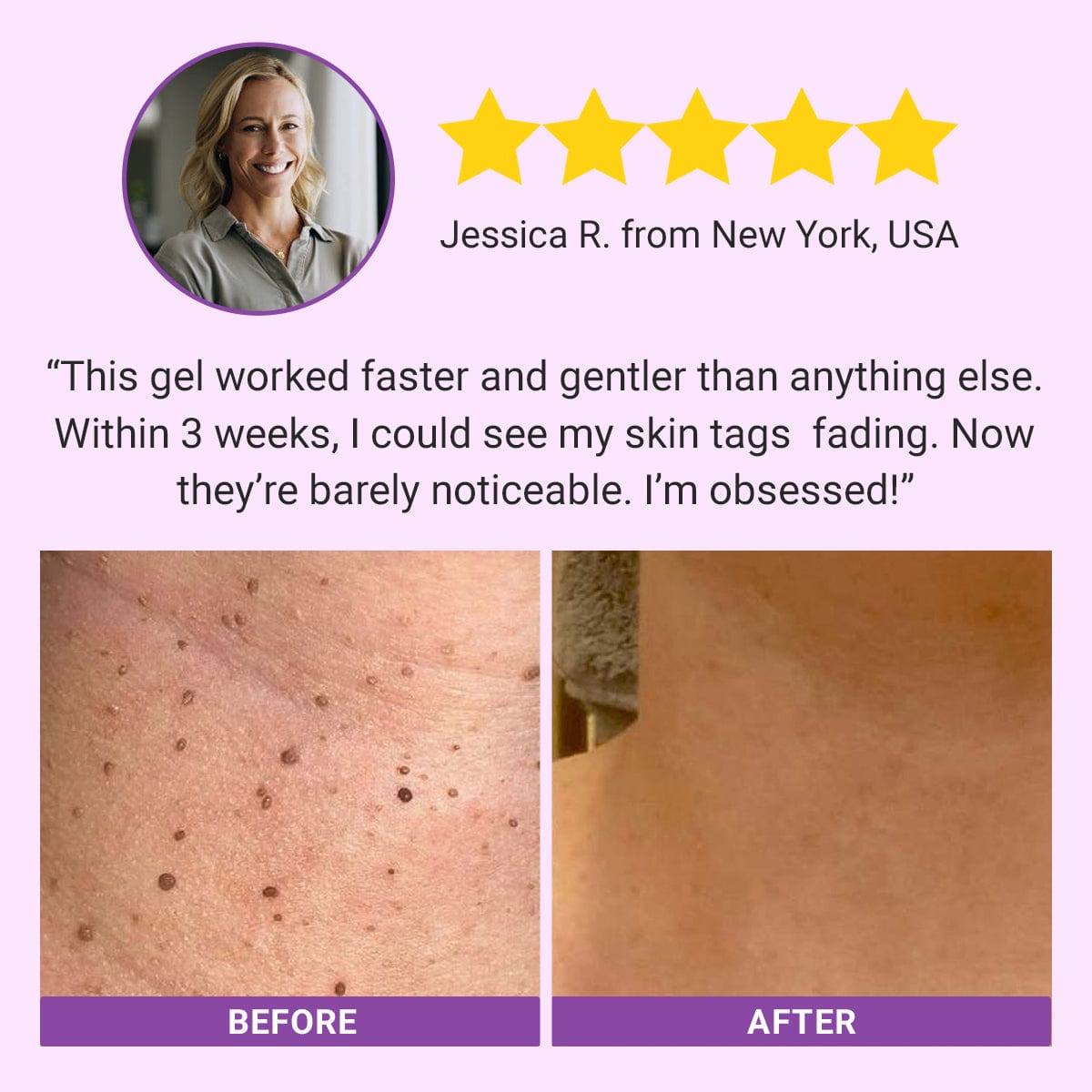 Fivfivgo® DermaClear Mole and Dark Spot Removal Bio-Gel