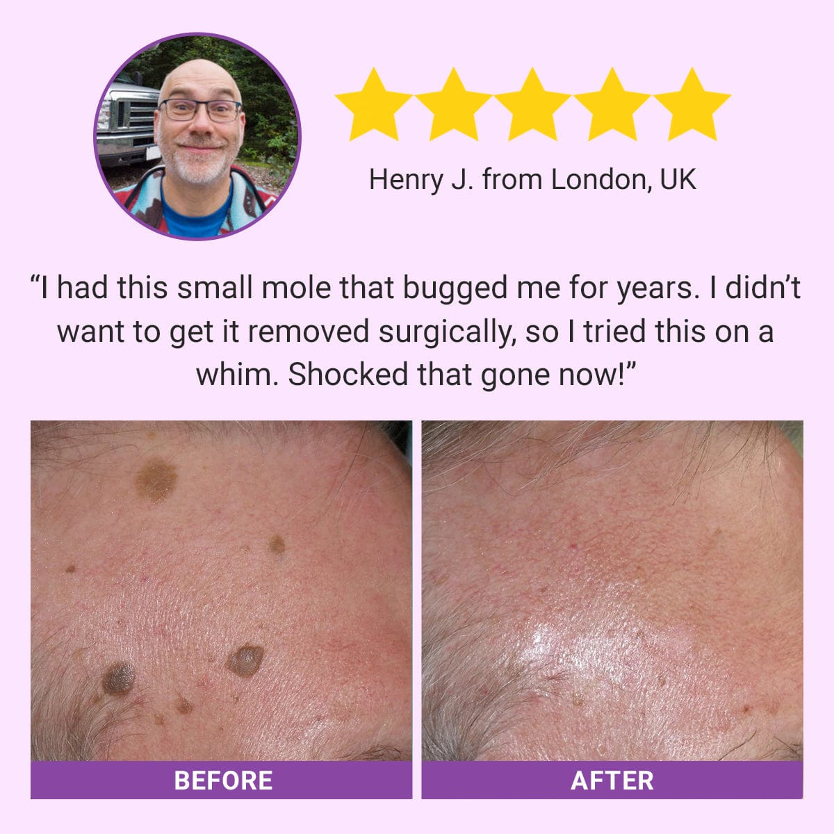 Fivfivgo® DermaClear Mole and Dark Spot Removal Bio-Gel