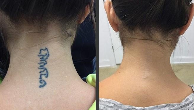 Permanent Tattoo Removal Cream