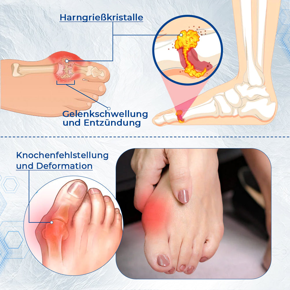 Fivfivgo™ Hallux-Valgus-Korrekturhilfe