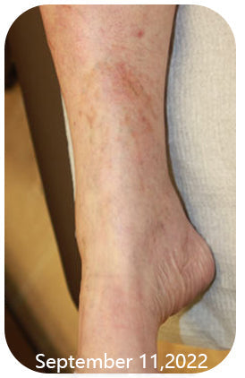 Fivfivgo™ Anti Knöchelödem Socken