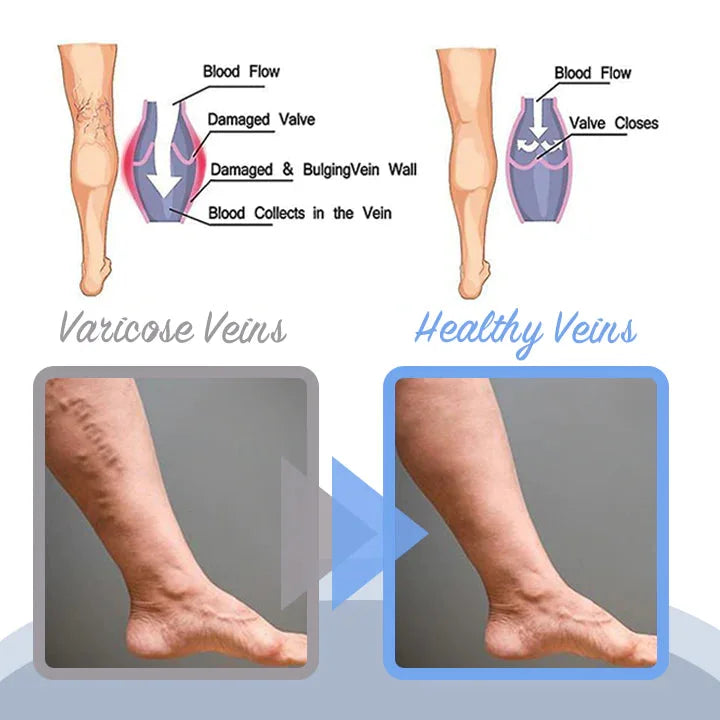 Fivfivgo™ Varicose Veins Spray