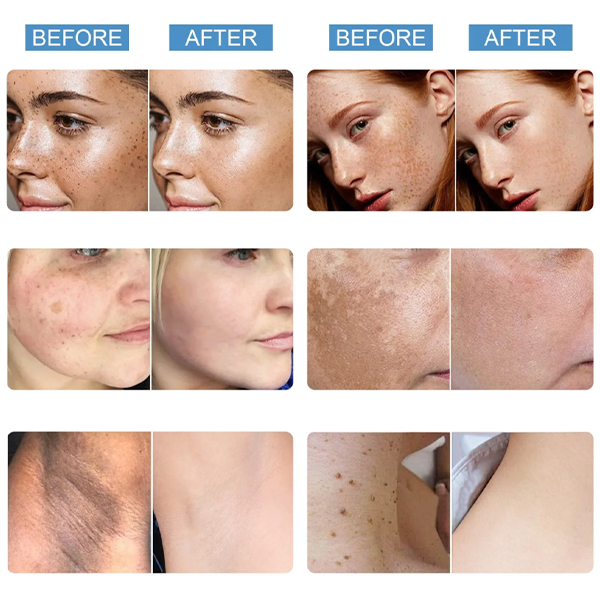Fivfivgo™ Blemish Treatment Serum für dunkle Flecken & Acanthosis Nigricans & Skin Tag