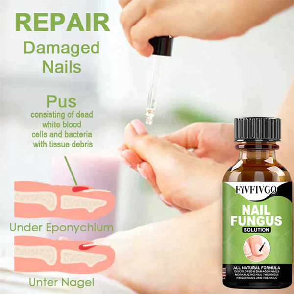 Fivfivgo™ FootCure Removal Paronychia Gel