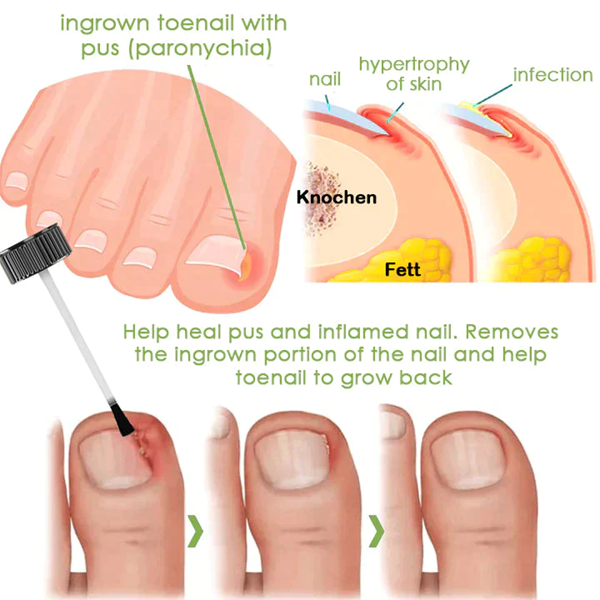 Fivfivgo™ FootCure Removal Paronychia Gel