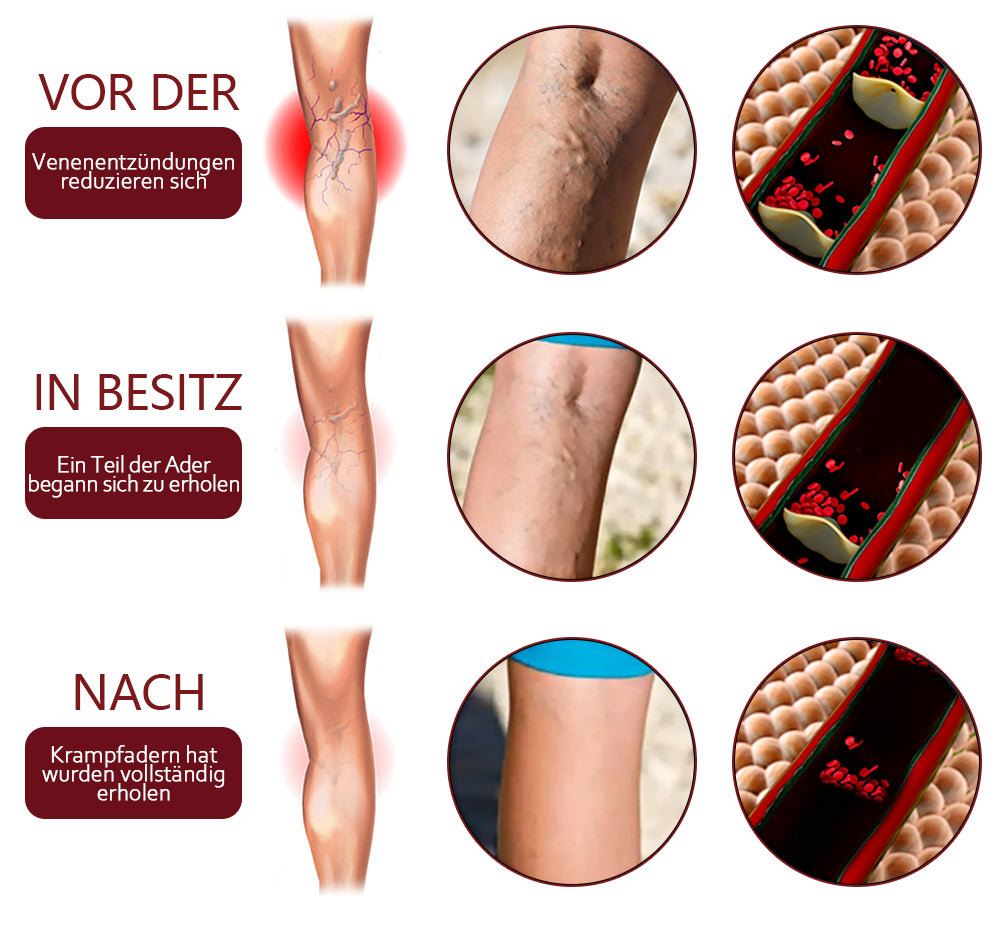 Fivfivgo™ VeinHealing Varizen Behandlungsspray