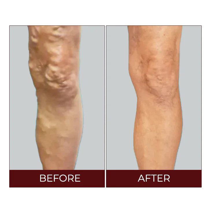 Fivfivgo™ Varicose Veins Relief Cream