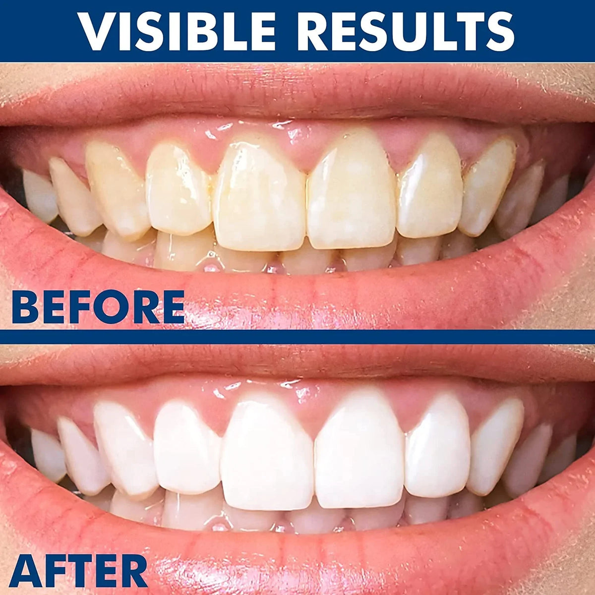 IonicWhite™ Teeth Whitening Essence