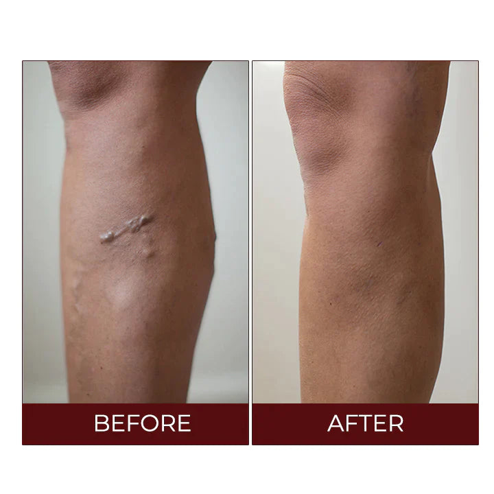 Fivfivgo™ Varicose Veins Relief Cream