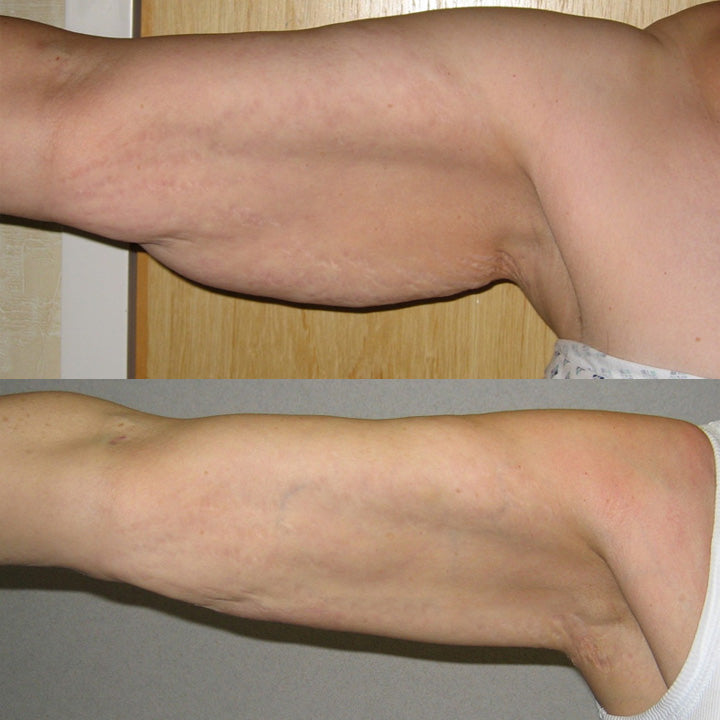 EMS Lymphdrainage-Massagekissen