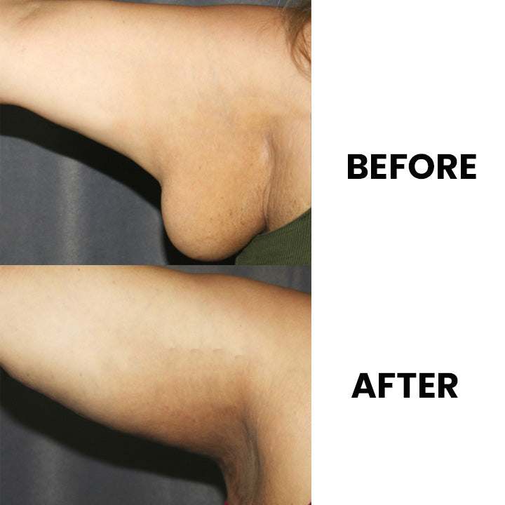 EMS Lymphdrainage-Massagekissen