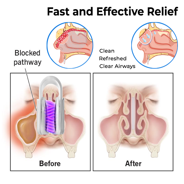 Oveallgo™ All Clear Nasal Mucus Cleaning Device