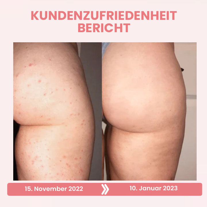 Fivfivgo™ BootyBoost AntiAkne Peeling Natürliche Seife