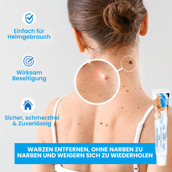 Fivfivgo™ MaximaleLeistung Salbe zur sofortigen Entfernung von Warzen