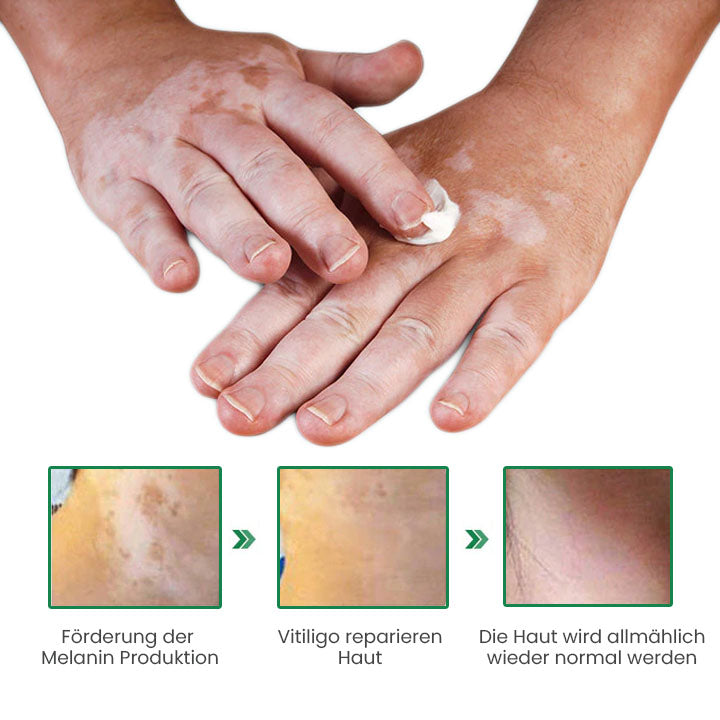 Fivfivgo™ VitiligoFix Revitalisierendes Elixier