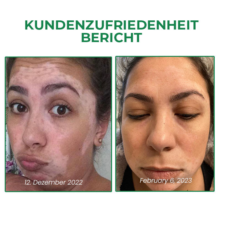 Fivfivgo™ VitiligoFix Revitalisierendes Elixier