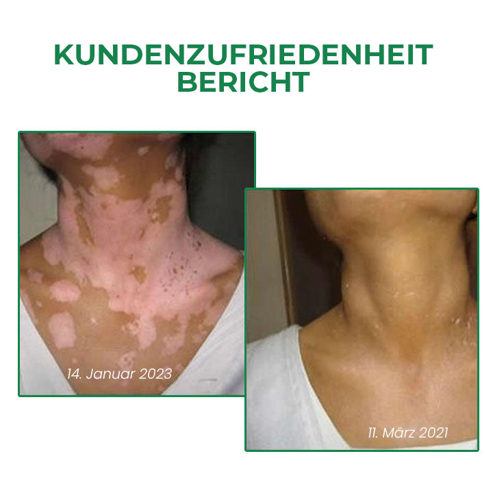 Fivfivgo™ VitiligoFix Revitalisierendes Elixier