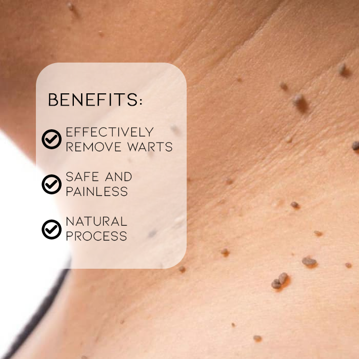 SimpClear All Natural At-Home Warts Remover